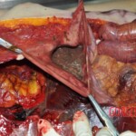 Autopsy of young woman