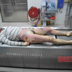 Autopsy of young woman