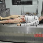 Autopsy of young woman