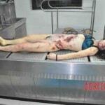 Autopsy of young woman