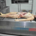 Autopsy of young woman