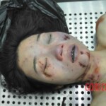 Autopsy of young woman