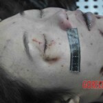 Autopsy of young woman