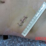 Dead young girl in morgue