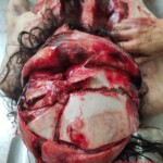 Young girl with cracked skull