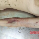 Young girl with cracked skull