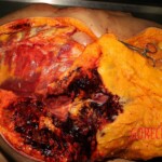 Autopsy of fat woman