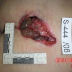 Dead woman in morgue