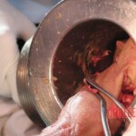 Hand in meat grinder