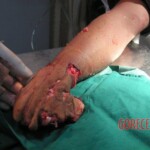 Hand in meat grinder