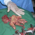 Hand in meat grinder