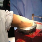 Hand in meat grinder