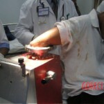 Hand in meat grinder
