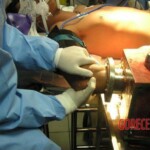 Hand in meat grinder