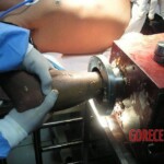 Hand in meat grinder