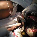 Hand in meat grinder