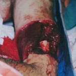 Traffic accident victim