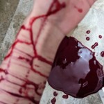 Multiple cuts on arm