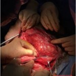 Gigantic neck cancer