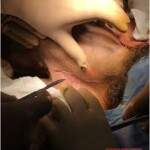 Gigantic neck cancer