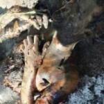 Burned Ukrainian girl