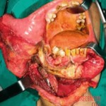 Consequences of oral cancer