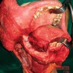 Consequences of oral cancer