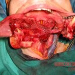 Consequences of oral cancer