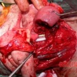 Consequences of oral cancer