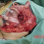 Consequences of oral cancer