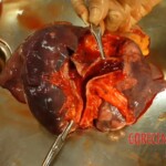 Autopsy of latina girl