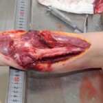 Autopsy of female jumper