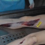 Autopsy of female jumper