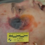 Autopsy of female jumper