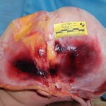 Autopsy of female jumper