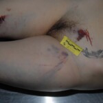 Autopsy of female jumper