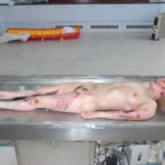 Autopsy of female jumper