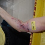 Autopsy of female jumper