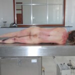 Autopsy of female jumper