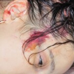 Autopsy of female jumper