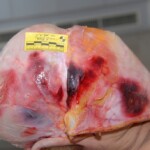 Autopsy of female jumper