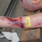 Autopsy of female jumper