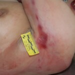 Autopsy of female jumper