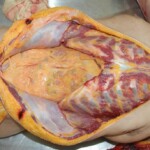 Autopsy of female jumper