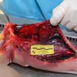 Autopsy of female jumper