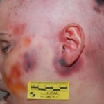 Autopsy of female jumper