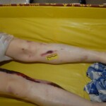 Autopsy of female jumper