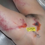 Autopsy of female jumper