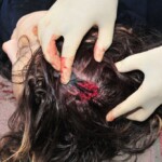 Autopsy of female jumper