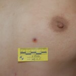 Autopsy of female jumper